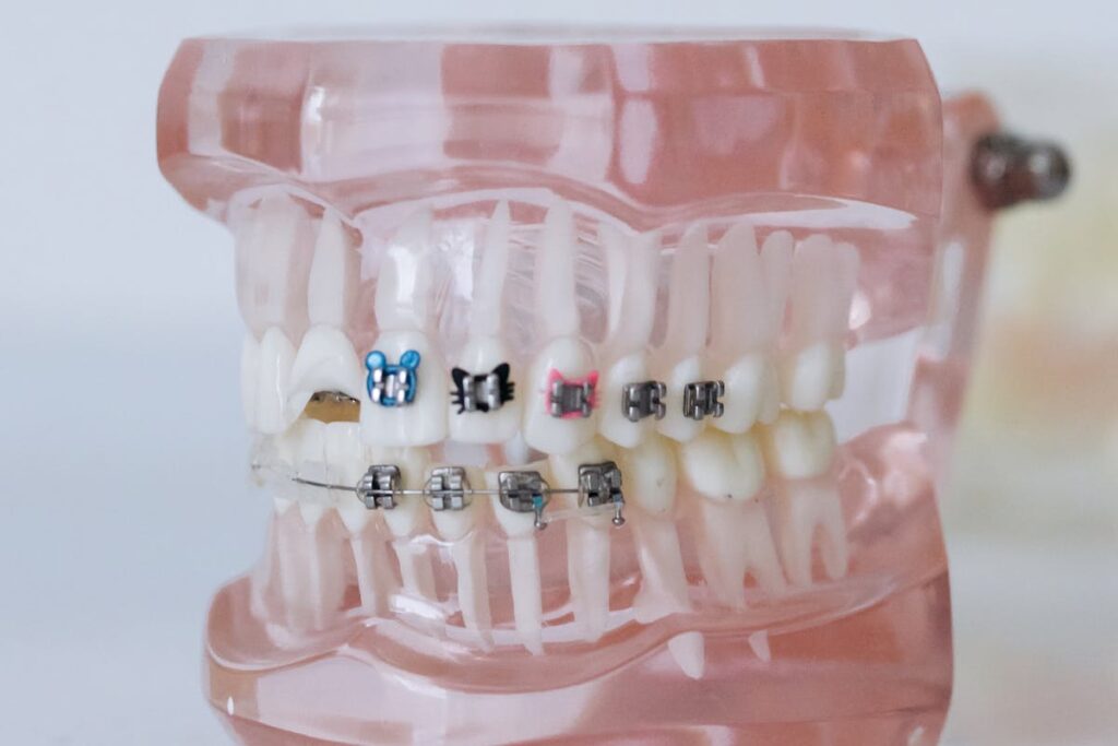 Close-Up Shot of Dentures With Braces