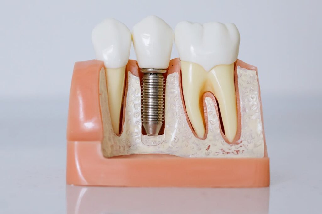 Close-Up Shot of Dental Implant Model