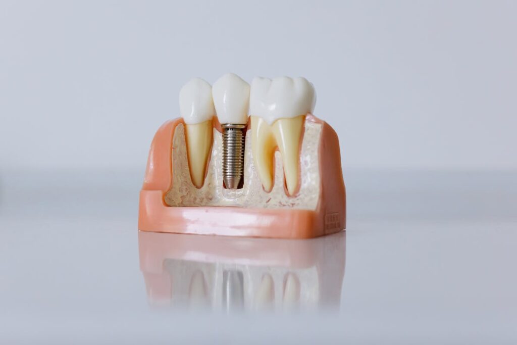 Close-Up Shot of Dental Implant Model