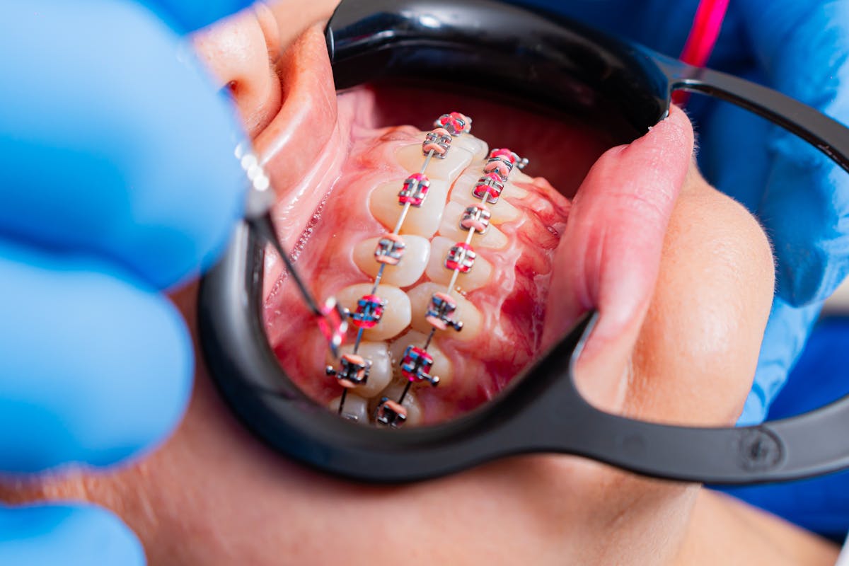 Dentist Working on Patient Teeth with Brackets