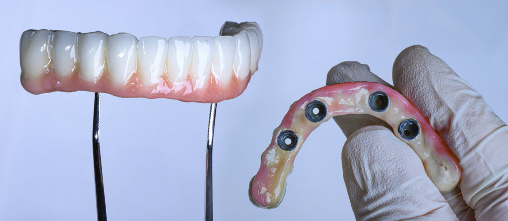 Dental implant supported full arch porcelain dental prosthesis for edentulous jaws in dentistry. Intraosseous dental implant and full arch dental prosthesis treatment. smile makeover.